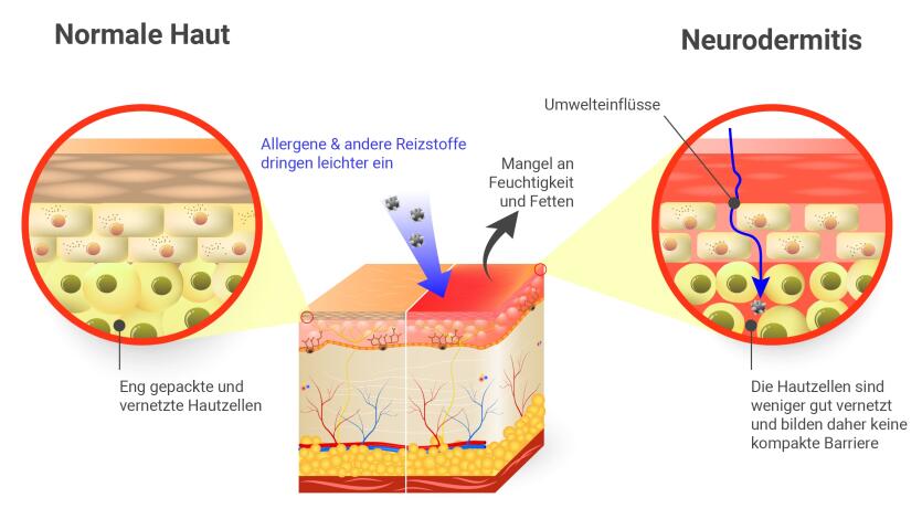 Neurodermitis Ursachen