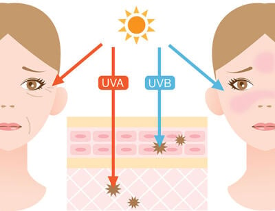 Sonnenallergie Ursachen: UV-A Licht Grafik