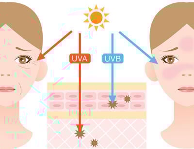 Sonnenbrand Symptome: UV-A Licht